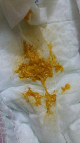 Con e cứ bú mẹ đc 1 lúc là đi ngoài phân vàng lỏng có dịch nhầy nữa. Hiện tượng này là bth hả các m?