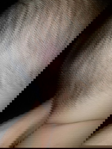 Bukol sa ulo ni baby