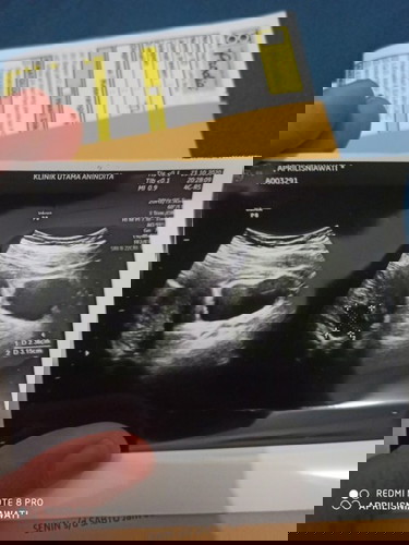 Cek kandungan ternyata ada kista