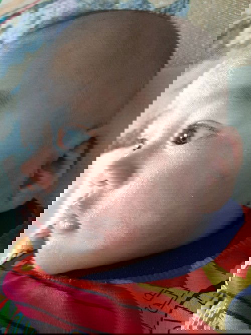 ผดผื่นลูกน้อย