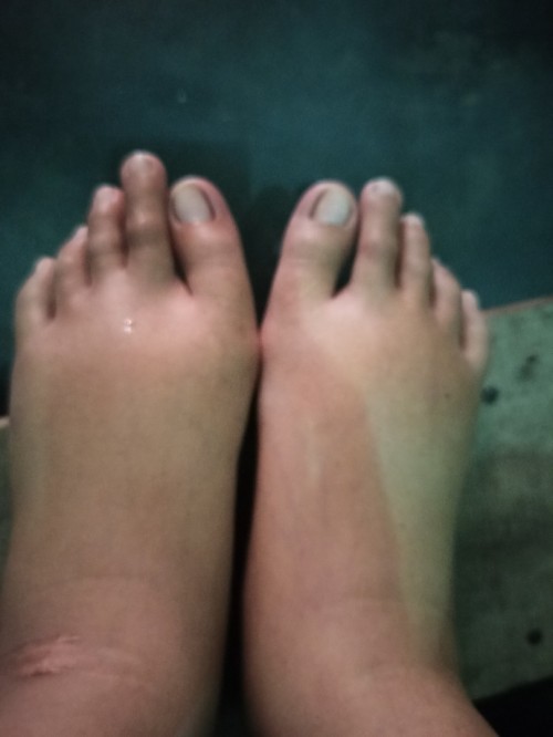 kaki bengkak