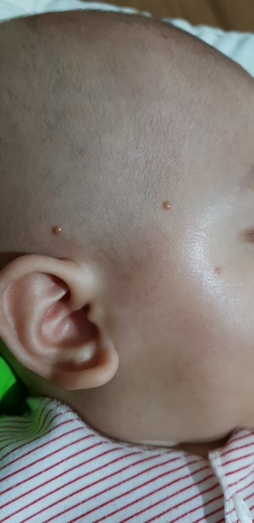 bintik2 pada kulit bayi