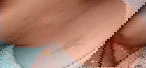 Cacar itu kek bgmn yah?