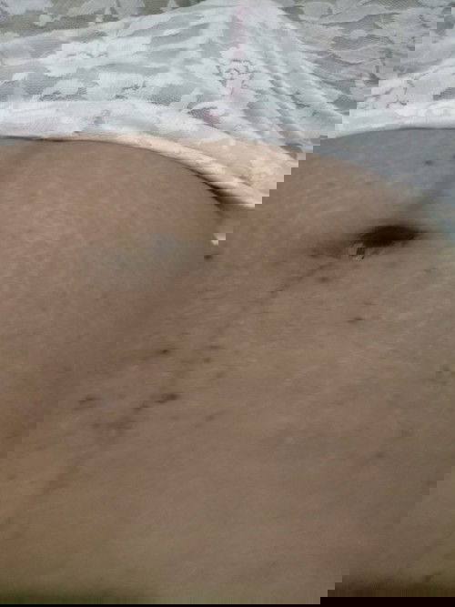 Hyperpigmentasi berlebih