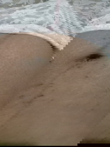 Hyperpigmentasi berlebih