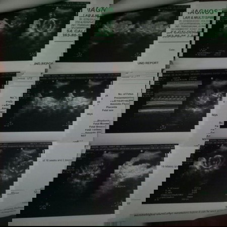 Ultrasound