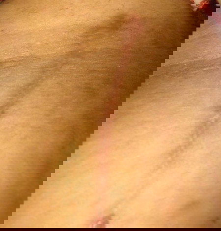 Keloidddddd
