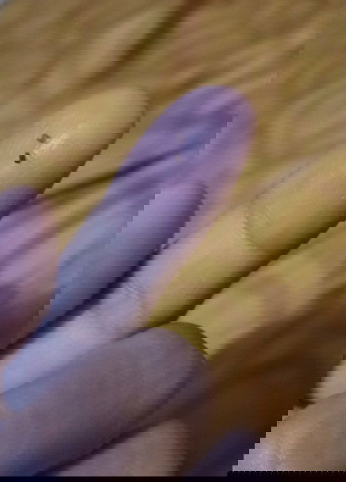 Puting Payudara kering