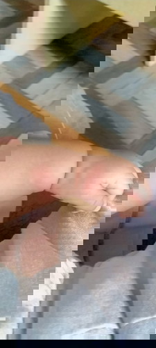 Insect bites