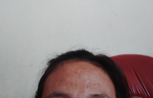Saya hmil ke2 usia kandungan 21weeks wajah saya koq jerawatan kira² bawahan bayi/tdk ada yg sma gak?