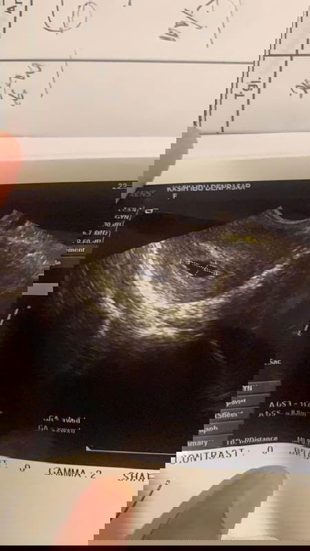 Hasil USG trimester I