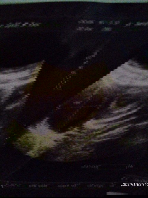 Ada kista Dalam Rahim, Bisa Lahiran Normal?