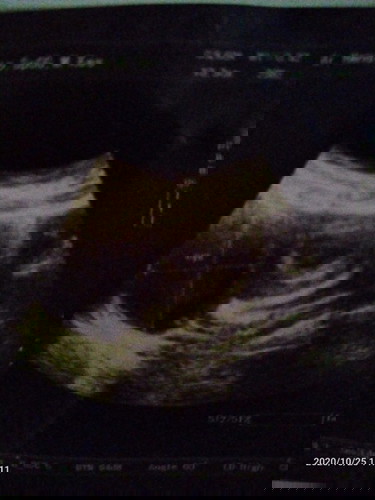 Ada kista Dalam Rahim, Bisa Lahiran Normal?