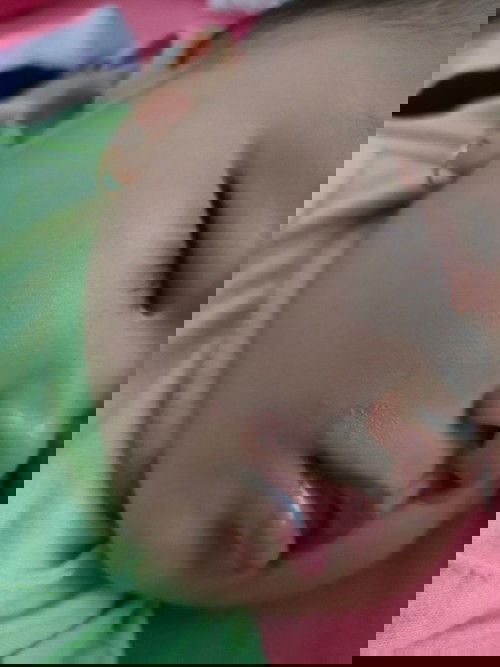 Bercak di dekat bibir bayi