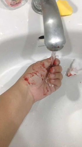 ใครเลือดกำเดาไหลบ้างคะ