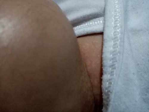 rashes