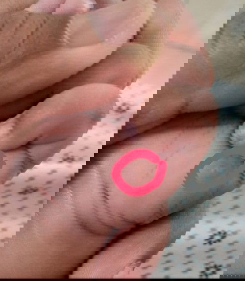 benjolan kecil apa ya?