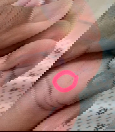 benjolan kecil apa ya?