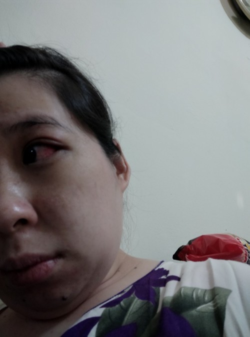 Bumil ada yg sakit mata ga selama hamil?