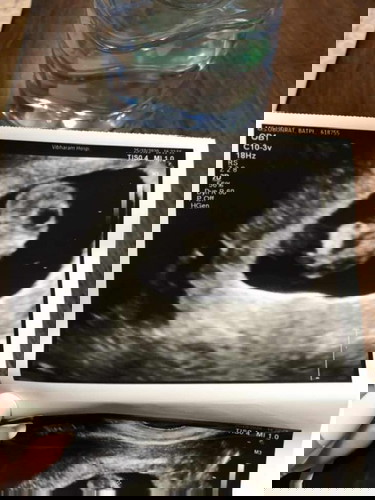 ยุติการตั้งครรภ์ 9 สัปดาห์ ซาวด์แล้วไม่พบหัวใจ