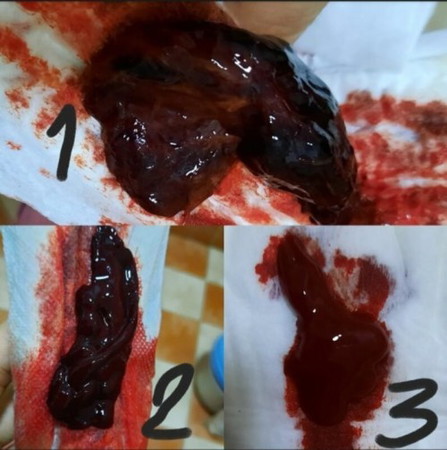 อาการแบบนี้เป็นปกติ หรือรกค้างหรือตกเลือดคะ มีใครเคยเป็นคล้ายๆกันมั้ยแล้วมันจะหายเองหรือต้องรักษาคะ