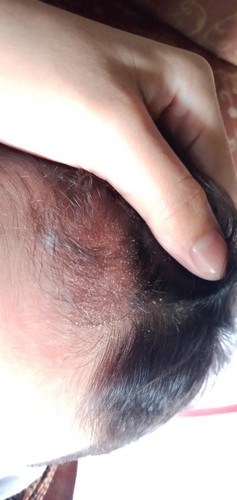 Assalamu’alaikum bun"
anak saya umur 1 bln,kulit kepalanya mengelupas, ap solusiny iy bun?