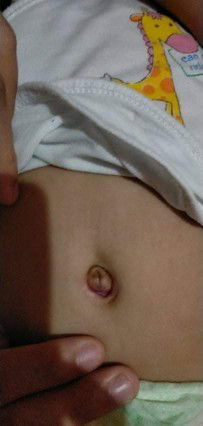 nakagasugat yung pusod ng anak ko