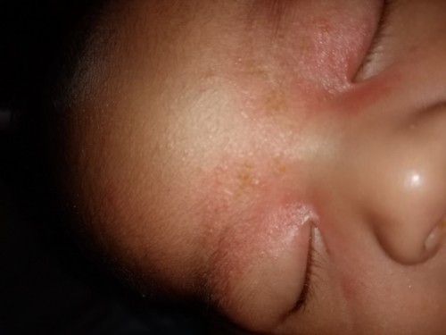 Ask ko lang po kung natural po sa baby yung namamalit balat ng ganto?nagiging medyo yellow pagnatuyo
