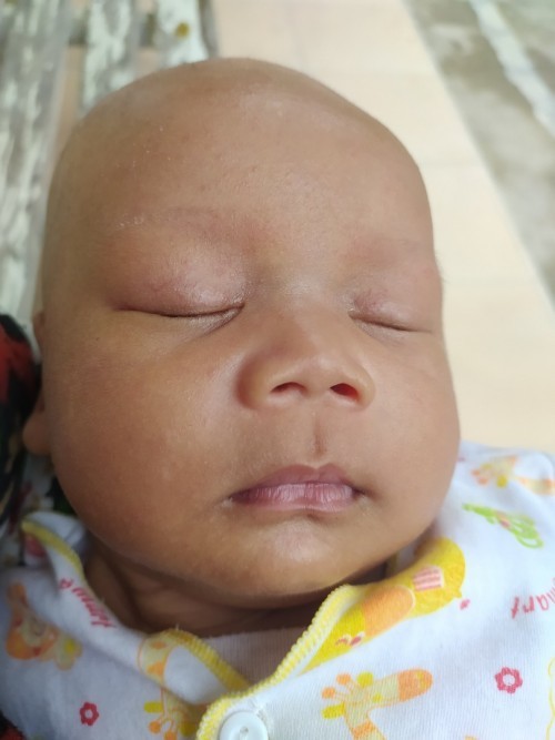 Bruntusan dimuka dan kepala