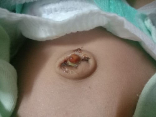 ขอคำปรึกษาเรื่องสะดือ