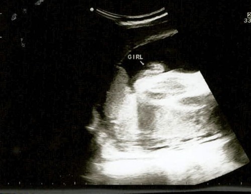Ultrasound