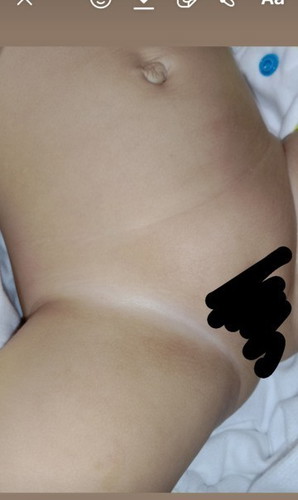 Pangingitim sa hita ni baby