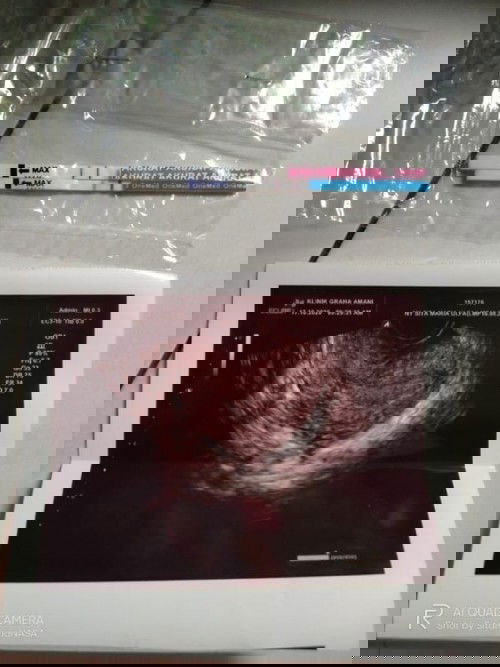 Telat 7hri hasil USG baru penebalan dinding rahim