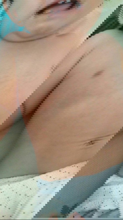 ruam merah setelah demam