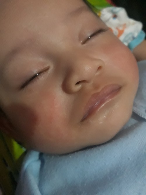 Bintik merah di pipi