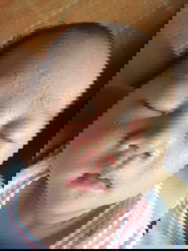 ลูกมีตุ่มจุดแดงๆกับตุ่มหนองเล็ก