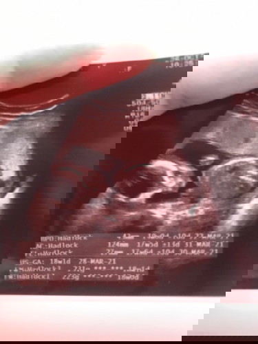 อัลตราซาวด์ ท้องแรก