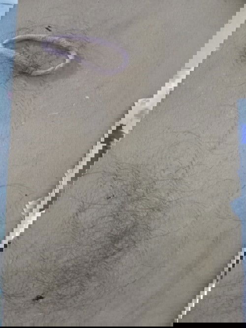 ผมร่วงบางขนาดลูกจำหน้า