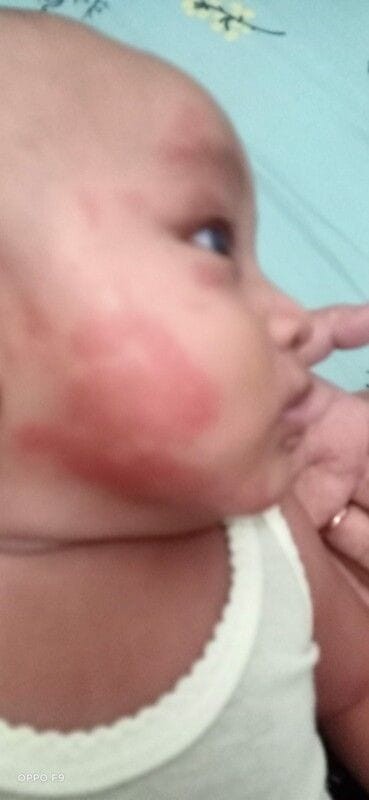 Ruam pipi,bukan ruam susu