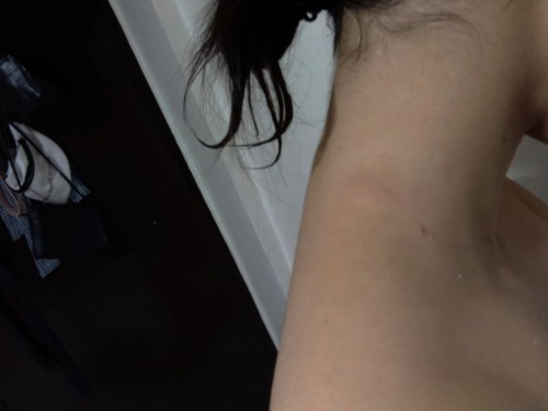 What is this? I just had this earlier this morning, mjo makati at parang namamaga na masakit pag tina touch ππ please help me know about this ππ»ππ»