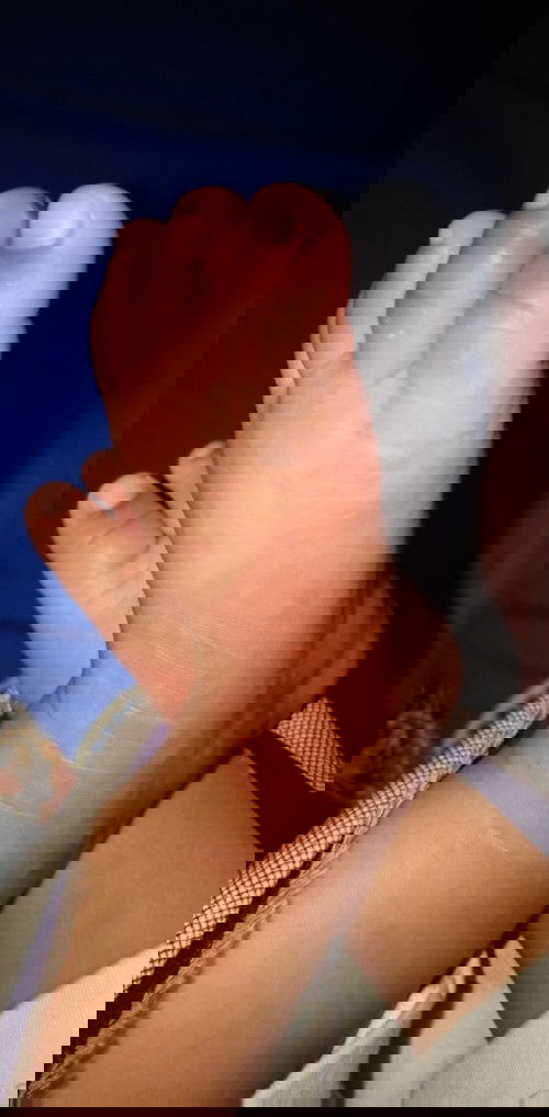 Alergi kaki bintik merah