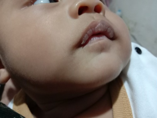Bibir bayi