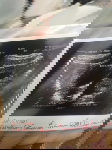 เพื่อนๆเคยมีเลือดออกระหว่างตั้งครรภ์ไหมค่ะ บ้านนี้พอเห็นก็ไปหาหมอแต่ฉีดกันแท้งไม่ได้เพราะไม่พบน้อง