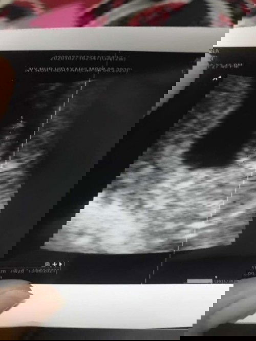 Ancaman kuret 2 minggu lagi