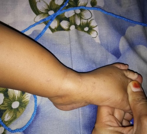 Obat Kutu Air Buat  Anak Umur 8 bulan