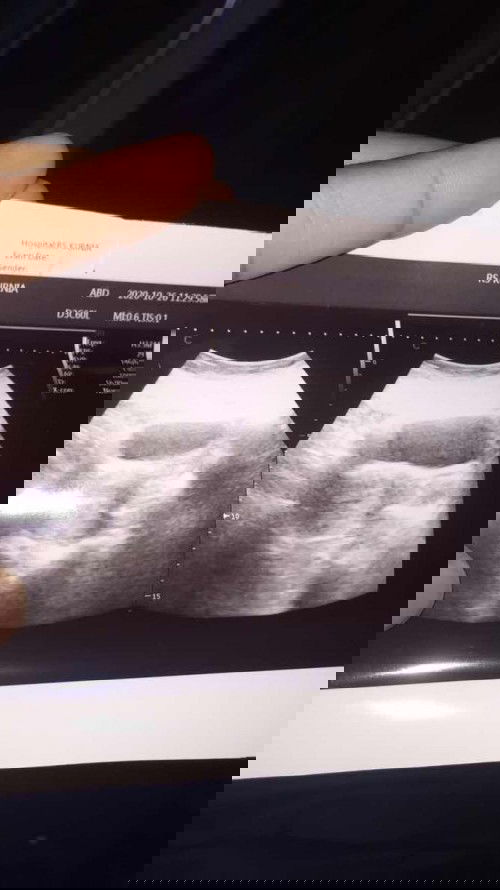 Usg 5 minggu belum terlihat janin?