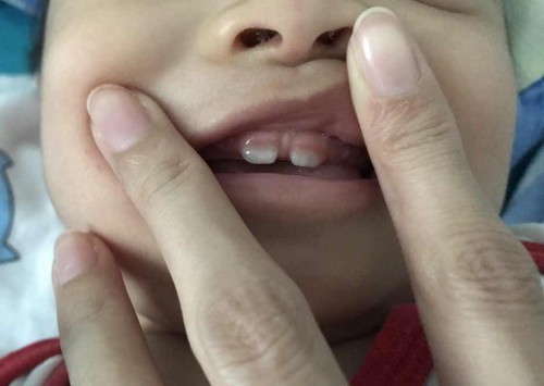 เรื่องฟันหน้า ฟันน้ำนม