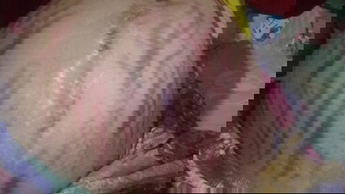 ท้องแตกลาย