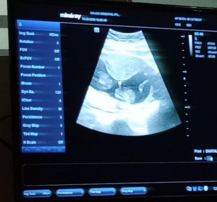 Contraction at 13 weeks