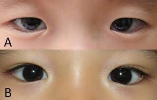 Entropion (eyelash problem)